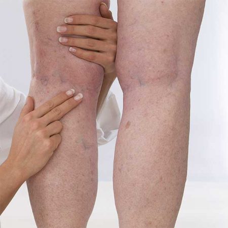 DVT_Dignosis_Woman_Leg_Vein DVT_Dignosis_Woman_Leg_Vein