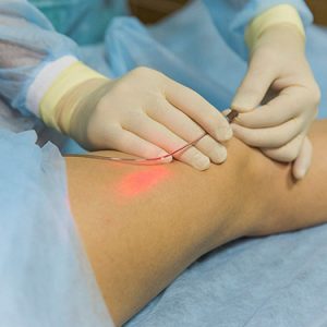 Endovenous-Laser-Treatment Endovenous-Laser-Treatment