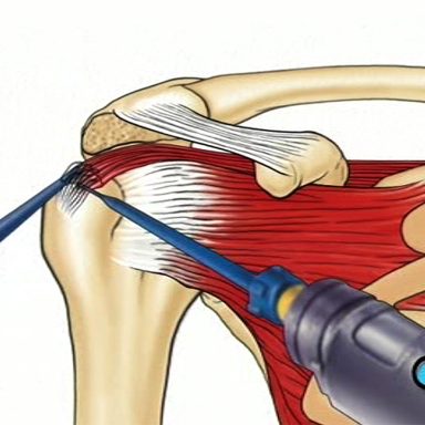 Arthroscopic Rotator Cuff Repair - What To Know? | CMW