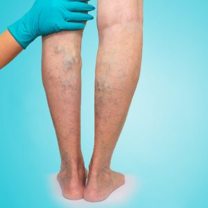 Chronic-venous A patient suffering 'Chronic venous' insufficiency during his check-up at Complete Medical Wellness New Jersey