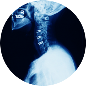 x-ray-of-Cervical-Disc-Replacement An x-ray of 'Cervical-Disc-Replacement' displayed at Complete Medical Wellness New Jersey