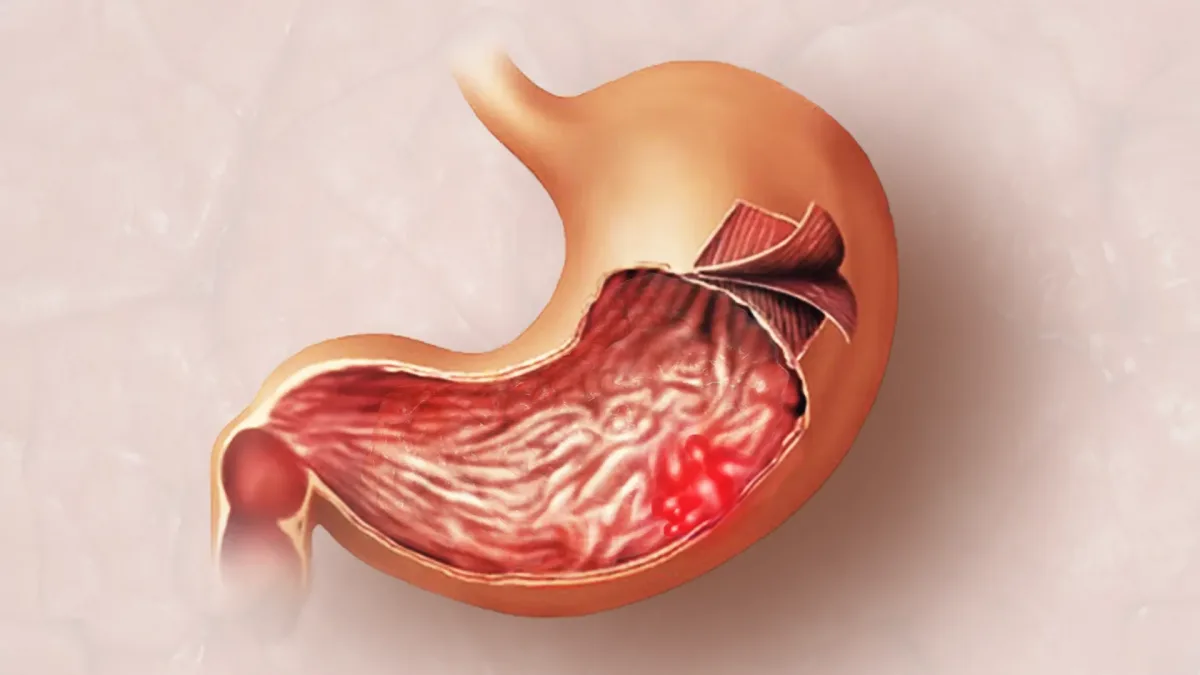 Stomach Cancer
