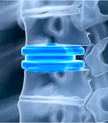 Disc-Replacement