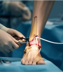 Microdisectoromy