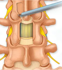 lminectomy